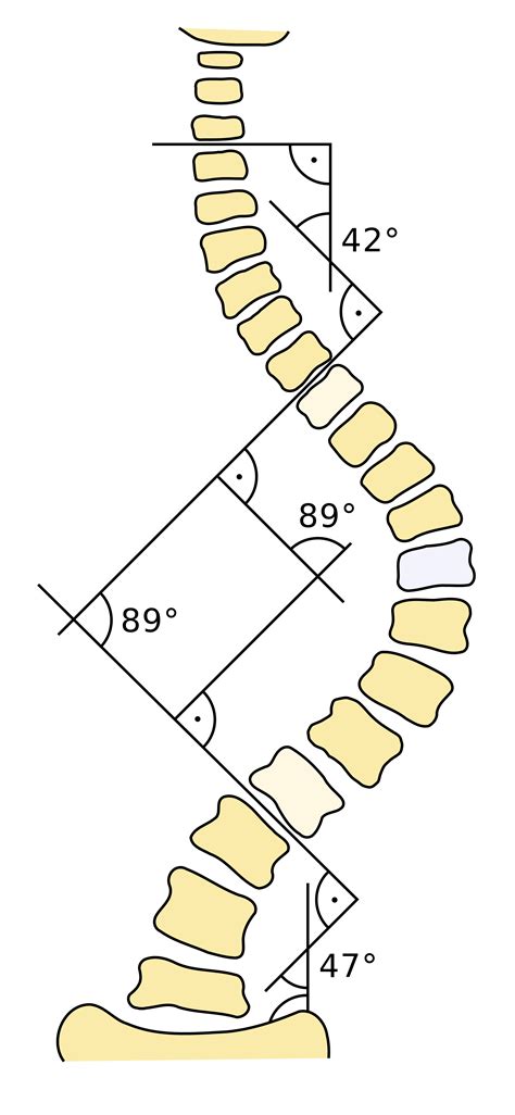 Scoliosis: SMA, Curvature of the Spine Causes and Treatment