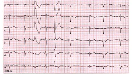 Ekg Practice Strips Printable
