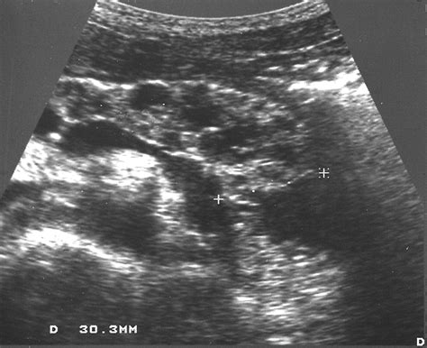 Pancreatic Cystosis in Children and Young Adults with Cystic Fibrosis ...