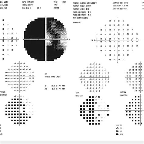 Image result for Abnormal Visual Field Testing