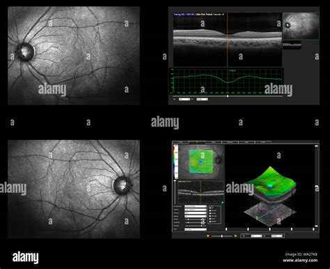 Retinal scan hi-res stock photography and images - Alamy - layers of retina oct