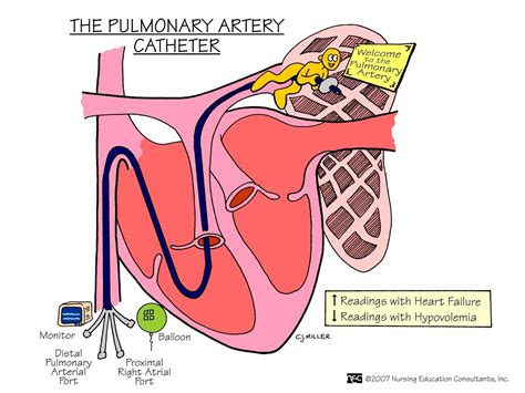 Image result for How Would You Draw SvO2 Form Pulmonary Artery Line