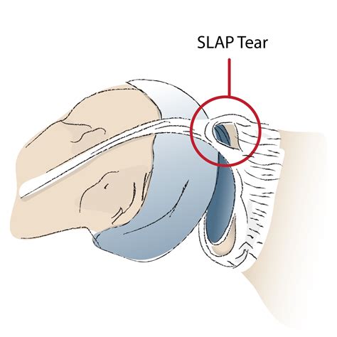 Can You Workout With a SLAP Tear? — Outlast Health and Performance — Maryland