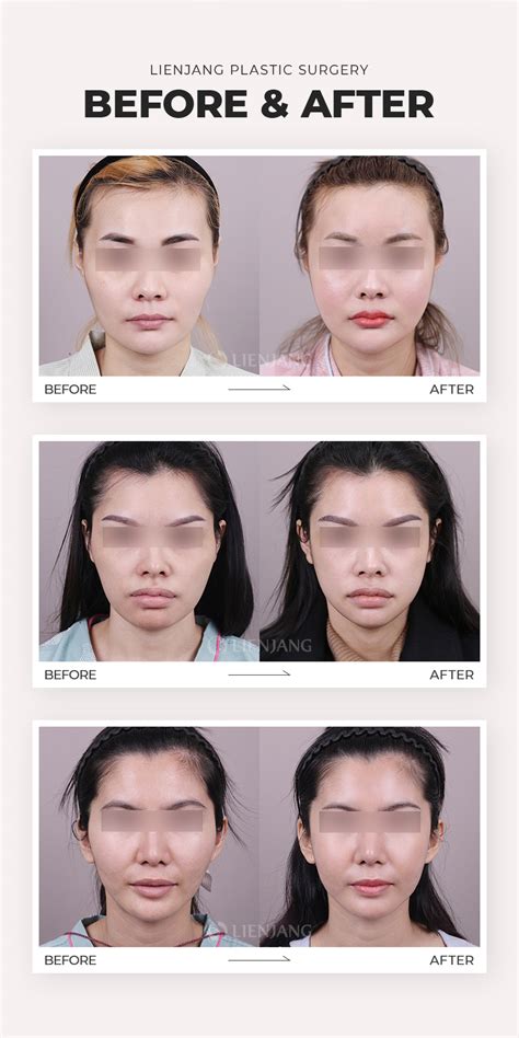 Image result for Cheekbones Reduction Book