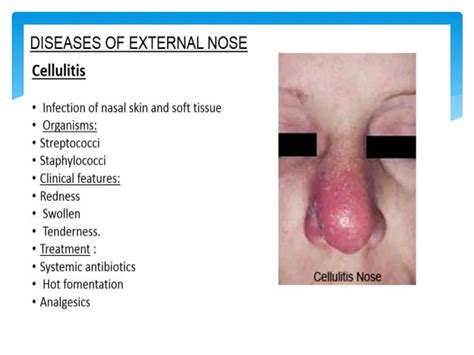 Diseases of nose and paranasal sinuses.pdf