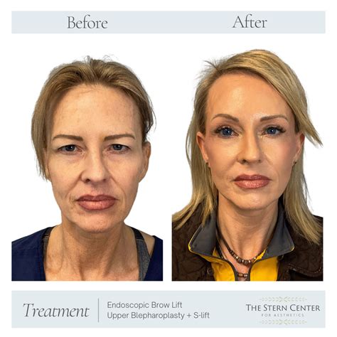 Endoscopic Brow Lift, Upper Blepharoplasty + S-lift - The Stern Center ...