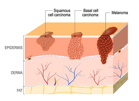 Image result for How Skin Cancer Forms
