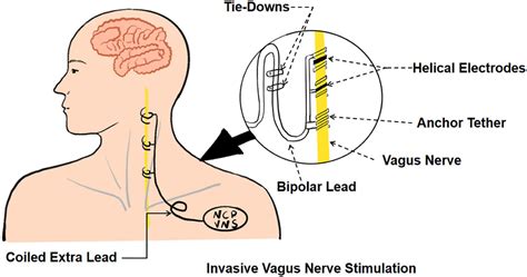 Lap Band Vagus Nerve Damage at Mark Ferretti blog