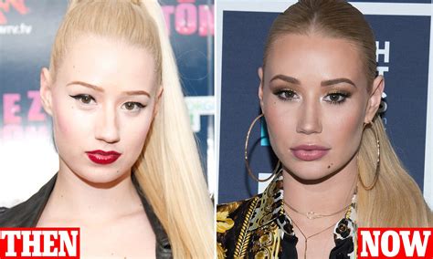 Iggy Azalea Face Surgery