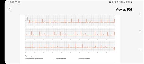 Image result for PVC ECG Reading