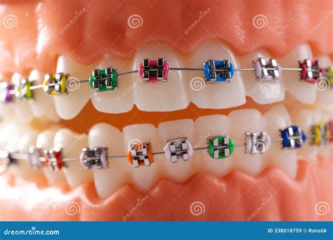 Metal Dental Braces for Teeth Straightening Stock Image - Image of sample, straightening: 338018759