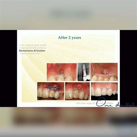 Success and failure in implant dentistry-One Dental is the Biggest ...