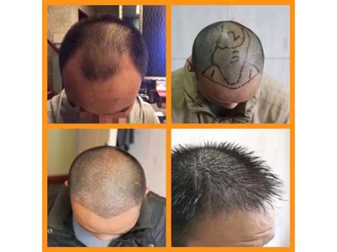 深圳青逸医疗美容门诊部-一家专注头发种植|毛发移植的连锁品牌机构
