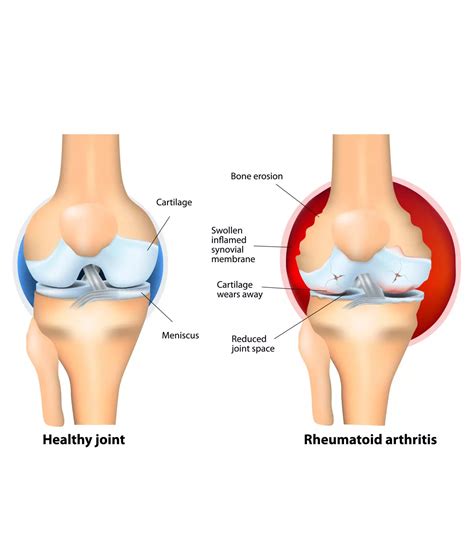 Postpartum Arthritis: 9 Effective Tips For Easing Joint Pain