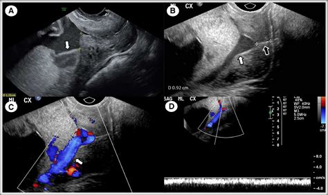 Placenta Prévia Marginal Cuidados - RETOEDU