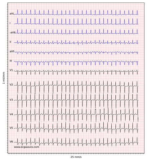 Atrial flutter: classification, causes, ECG diagnosis & management ...