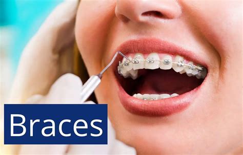 Your A-Z Guide to Invisible Braces for Teeth