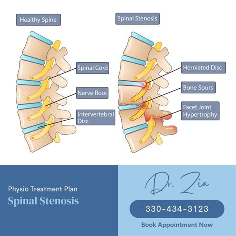 Spinal Stenosis | Causes, Treatment & Preventions