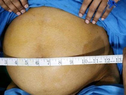 Kalwa hospital doctors remove gaint 6 kg fibroid from women's uterus