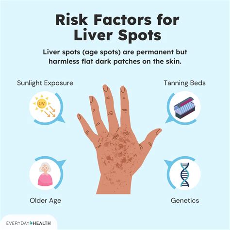 Liver Spots (Age Spots): Symptoms, Causes, Diagnosis, Treatment, and ...