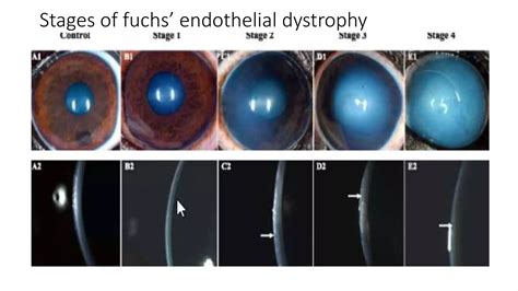Fuchs endothelial dystrophy mahfuz.pptx