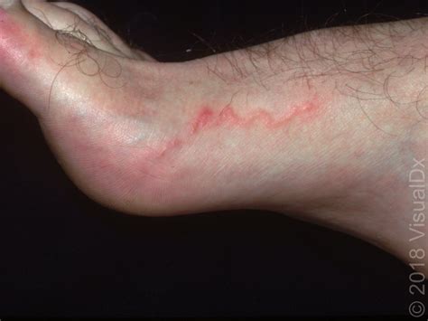 Image IQ: Foot and leg lesions that resemble a red line | Dermatology Times