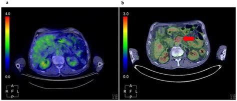 Cancers | Special Issue : Early Detection and Diagnosis of Pancreatic ...