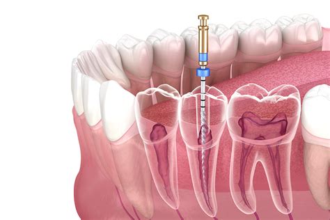 Root Canals Explained: Understanding the Procedure