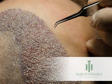 Hair Transplant Results Timeline: Month-by-Month Progress