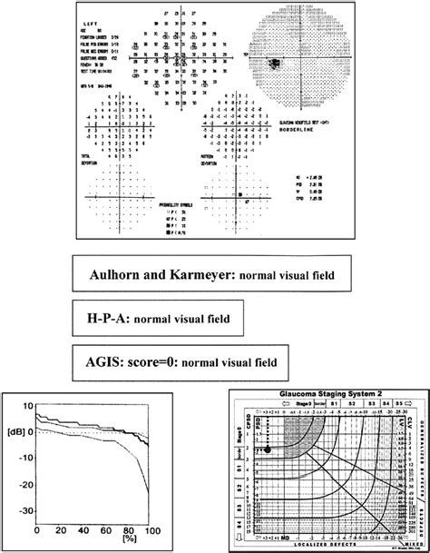 Image result for Paracentral Visual Field Defect