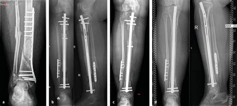 Das Precice®-Segmenttransport-System: eine Revolution in der rekonstru ...