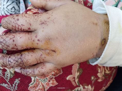 Image result for Open Fracture Surgery