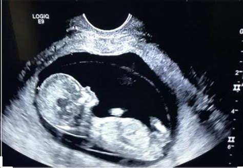 3个月胎儿性别图片_怀孕三个月胎儿性别图 - 随意云