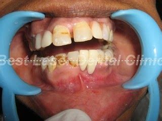 » lower front teeth replaced with dental implants