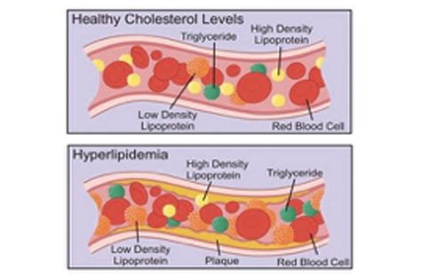 Hyperlipidemia