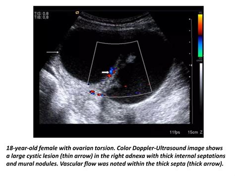 Presentation11, radiological imaging of ovarian torsion. | PPTX