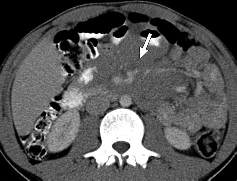 Childhood Burkitt Lymphoma: Abdominal and Pelvic Imaging Findings | AJR