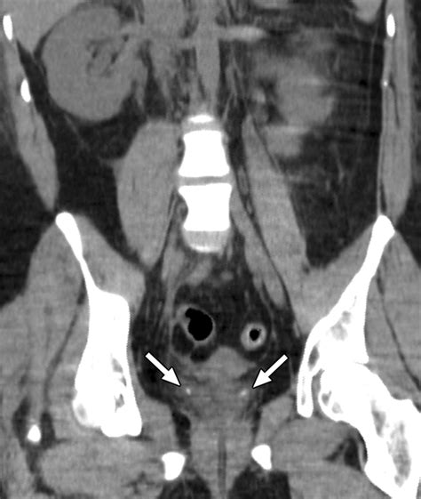 What the Radiologist Needs to Know About Urolithiasis: Part 2???CT Findings, Reporting, and ...