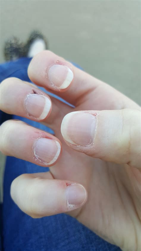 Fingernail Skin Peeling