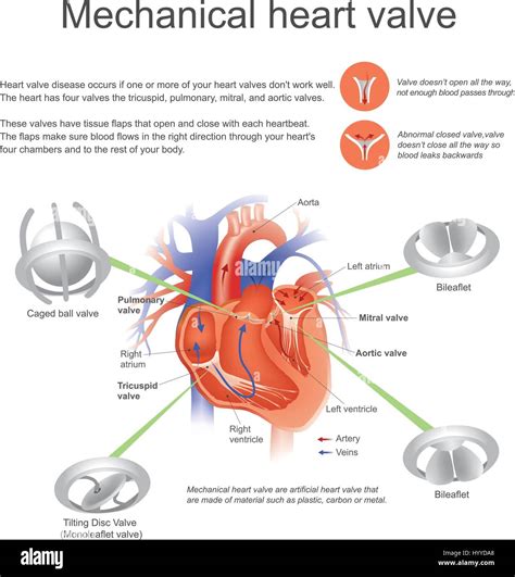 Mechanical Mitral Heart Valve
