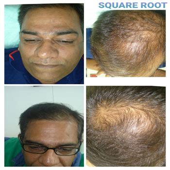 Best Skin Tightening Treatment In Gurgaon