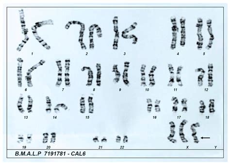 Unique Case Report: A Rare Association of 21-Hydroxylase Deficiency ...