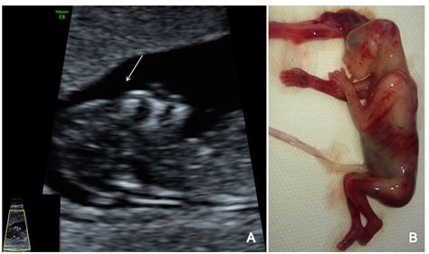 Trisomy 18 Ultrasound 13 Weeks
