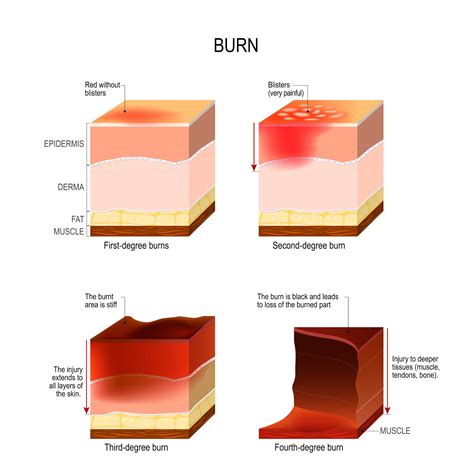 Fourth Degree Burn Diagram