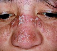 Image result for Lupus