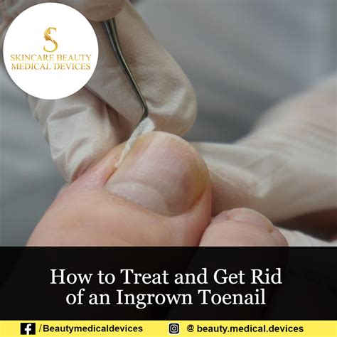 Ingrown Toenail From Climbing Shoes at Myrtle Garza blog