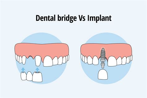 Implant-Supported Bridges | West Chester, PA Implant Dentist