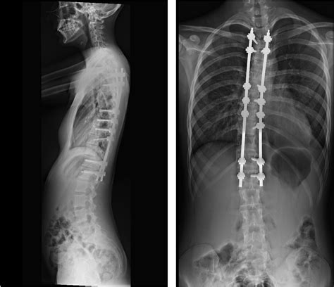 Minimally Invasive AIS SurgeryDr. Alejandro Peiró García - Neo Medical