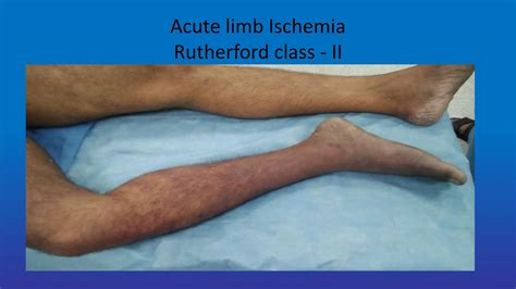 Diagnosis and management of Acute limb -ischemia (1).ppt