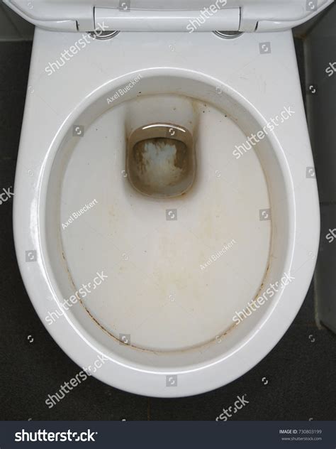 Kidney Stones In Toilet